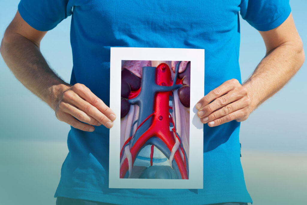 Aneurisma de aorta: causas e sintomas - Dr. Marcelo Giusti