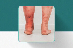 Trombose Venosa Profunda