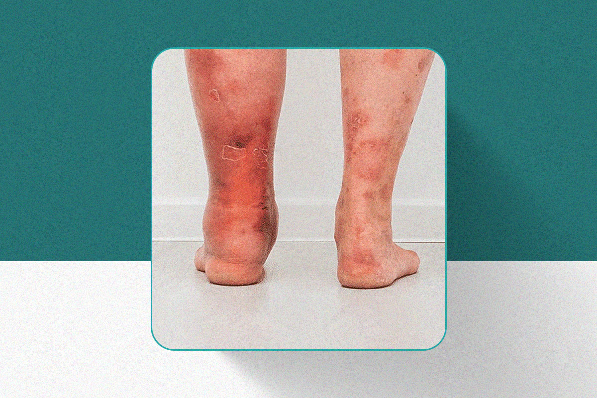 Trombose Venosa Profunda