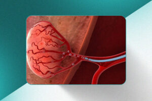 Embolização de Miomas Uterinos