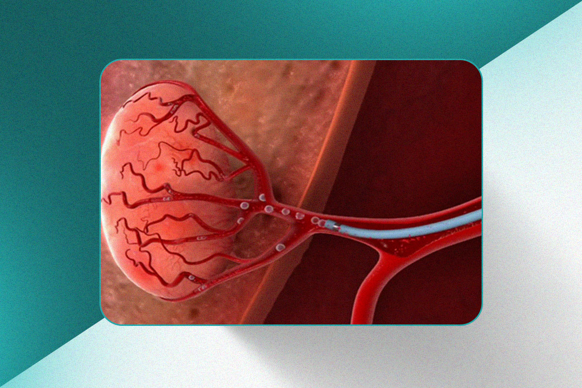 Embolização de Miomas Uterinos