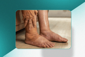 Pé diabético; revascularização