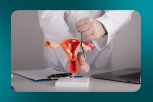 Embolização de miomas uterinos