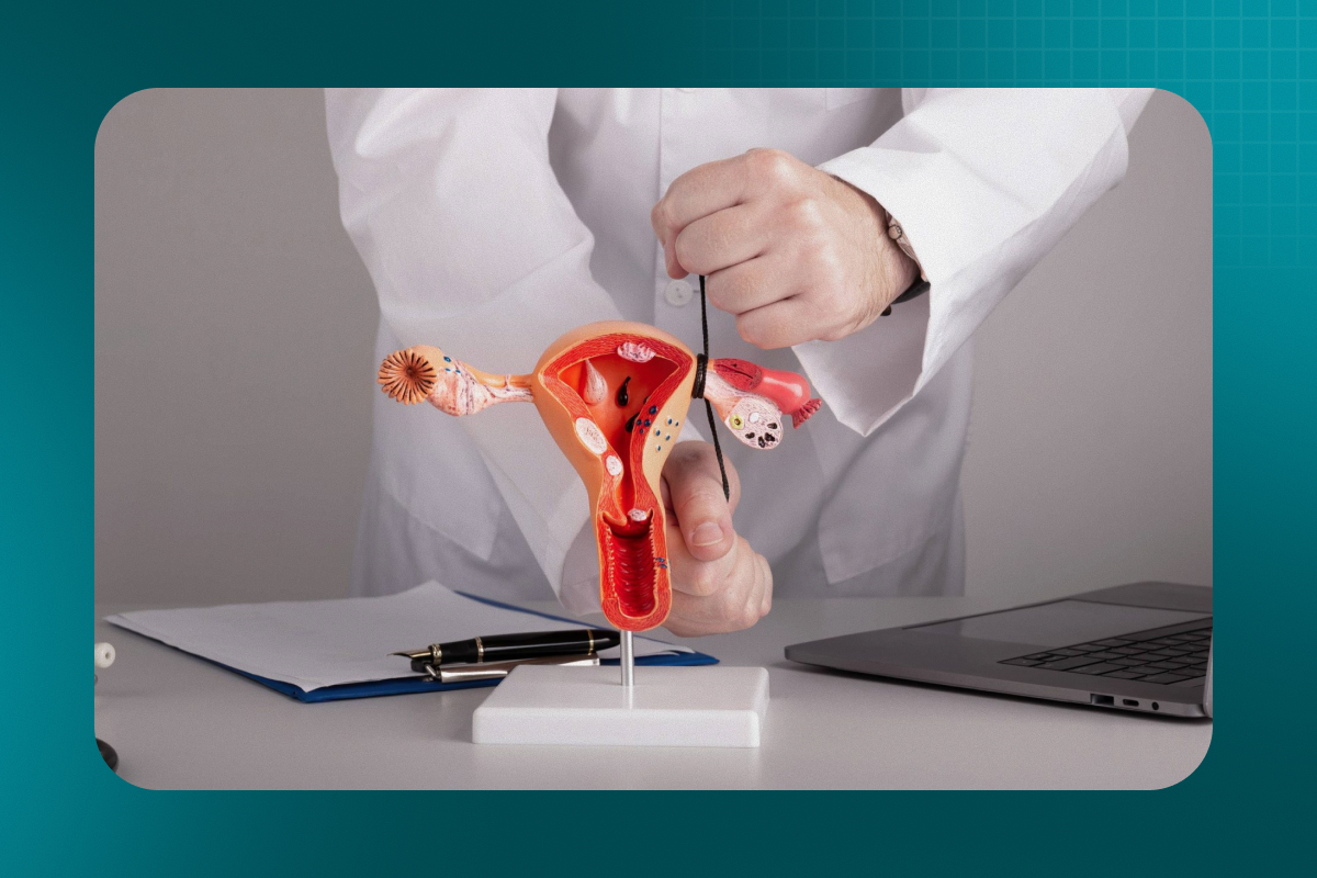 Embolização de miomas uterinos