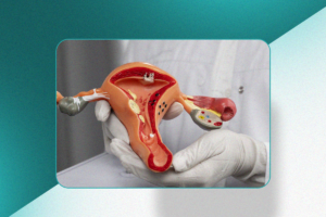 Embolização de miomas uterinos