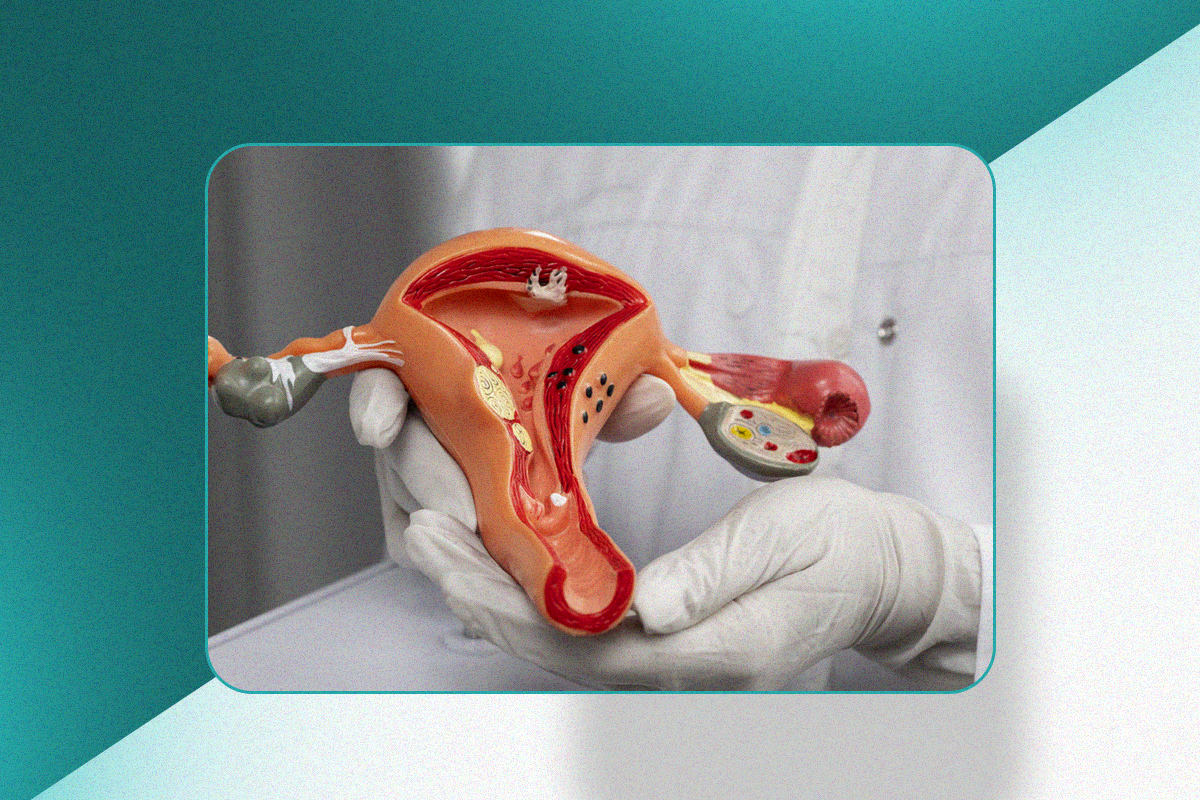 Embolização de miomas uterinos