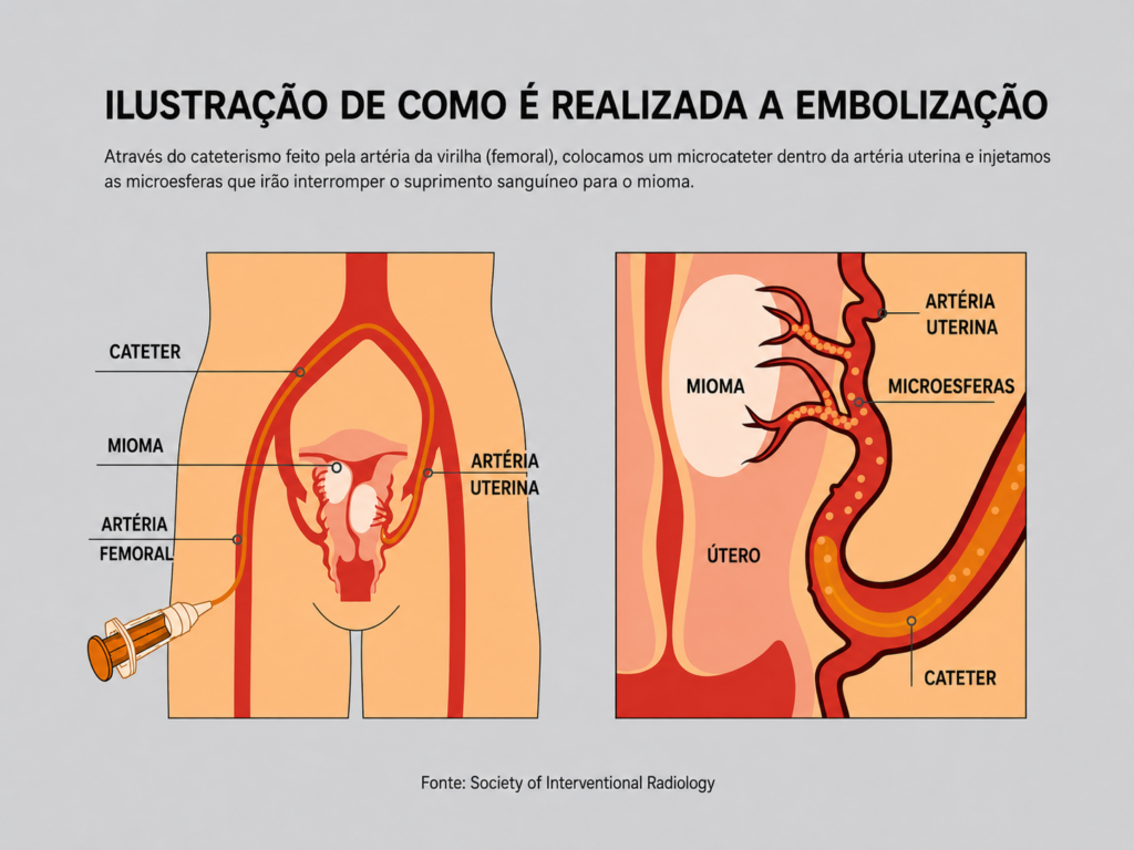 embolização de miomas uterinos