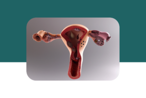 mioma uterino