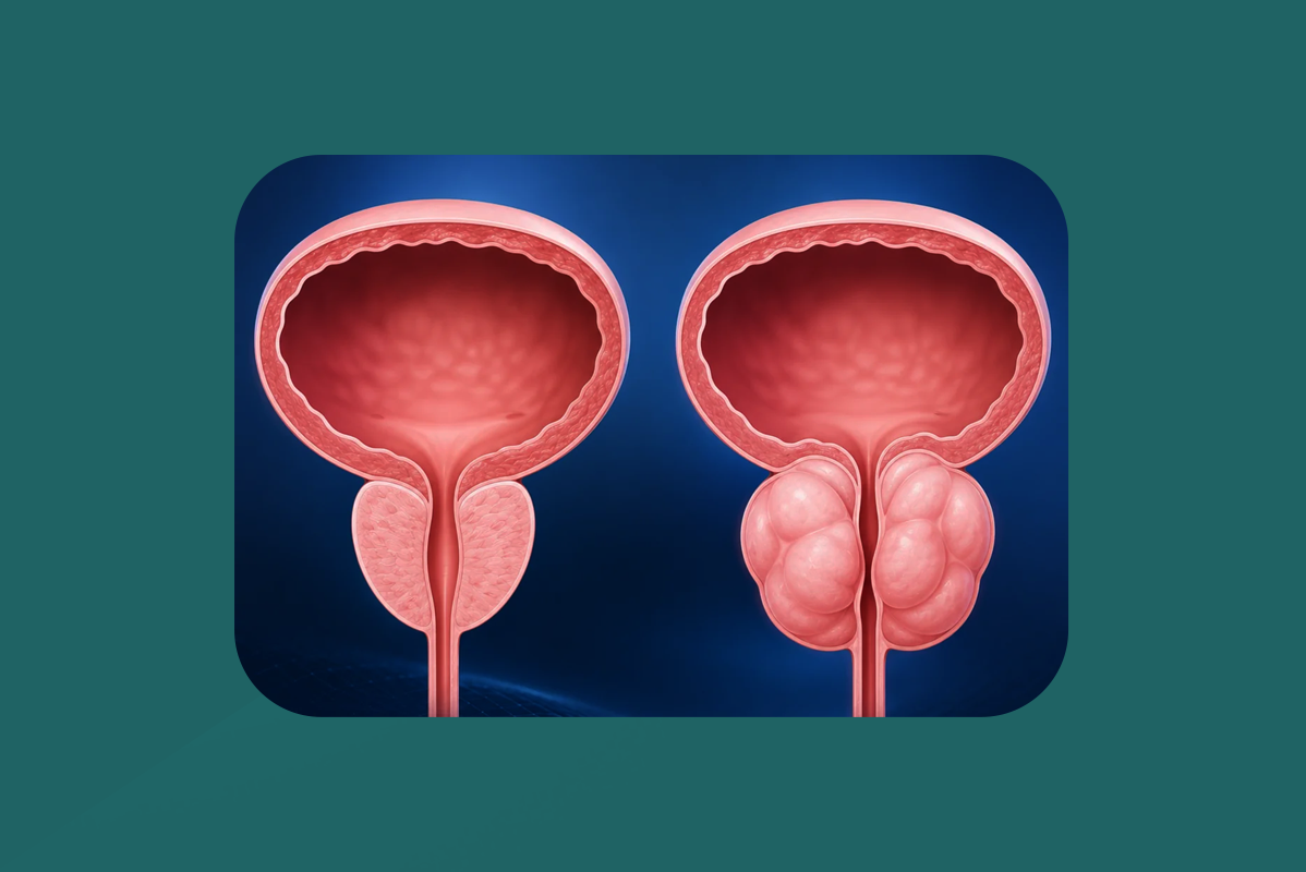 embolização de próstata; cirurgia da HPB